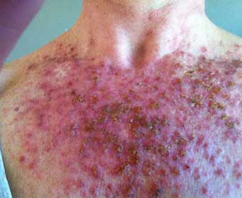 Treat eczema without steroid cream