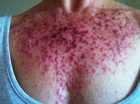 Steroid cream for rash side effects