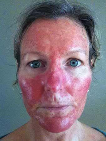 efudix ellis heather efudex aldara skin cream crema days four